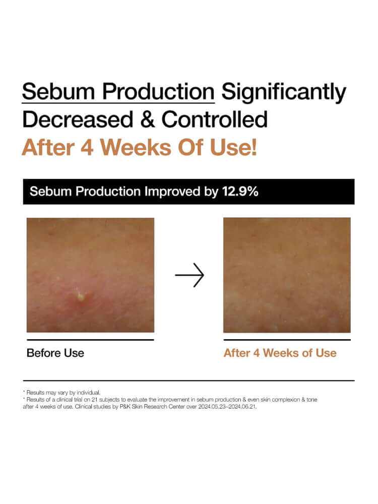 Image showing sebum production improvement after 4 weeks of use with before and after photos.