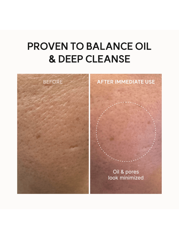 ARENCIA Blue Hyssop Cleanser results before and after deep cleansing, showing minimized oil and pores.