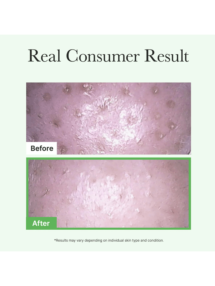 Real consumer results showing skin condition before and after using ARENCIA Pore Melt Mochi Cleansing Oil.