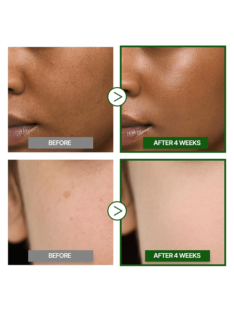 Before and after comparison of skin improvement using GOODAL Green Tangerine Vita C Dark Spot Care Cream Alpha.