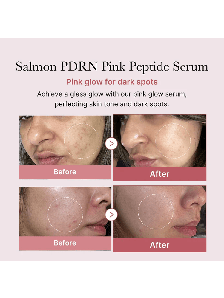 Before and after comparison showing results of MEDICUBE PDRN Pink Peptide Serum on skin tone and dark spots.