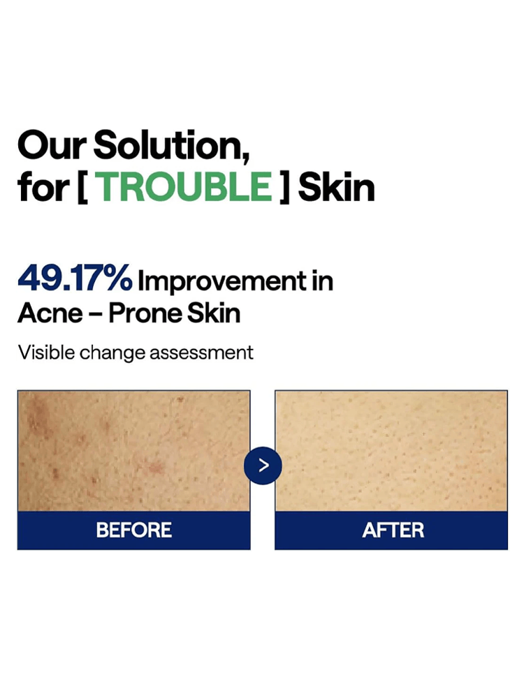 Before and after results showing 49.17% improvement in acne-prone skin; MEDIHEAL Teatree Trouble Pad effectiveness.