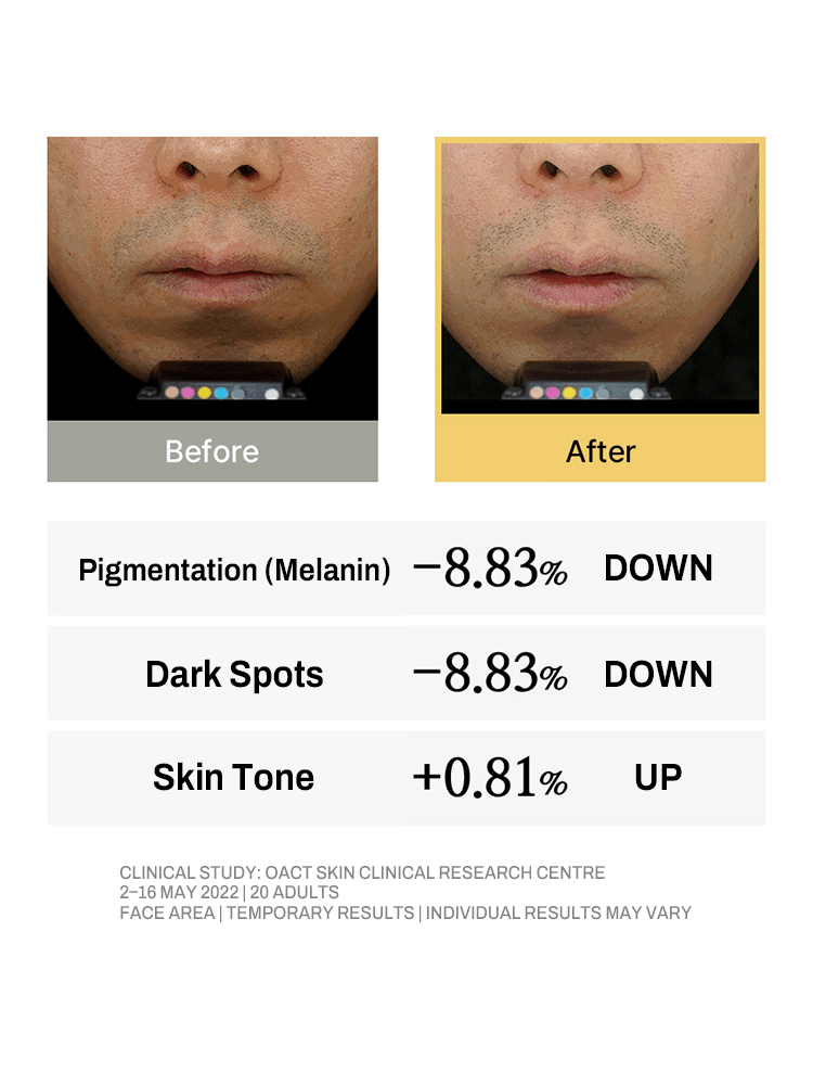 Before and after results showcasing MIP Vitamax All In One Lotion impact on skin tone, dark spots, and pigmentation.