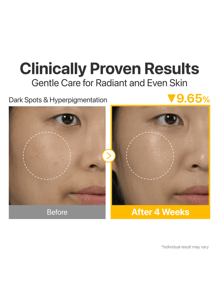Before and after results of NUMBUZIN No.5 Vitamin Concentrated Serum showing reduction in dark spots and hyperpigmentation.