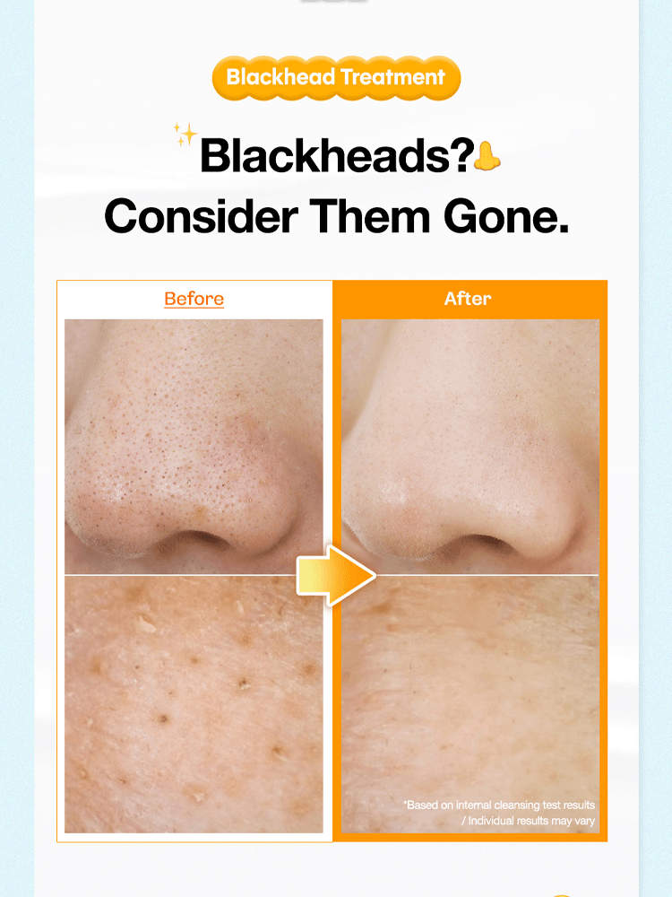 Before and after blackhead treatment results featuring clear skin after using manyo Pure Cleansing Oil.